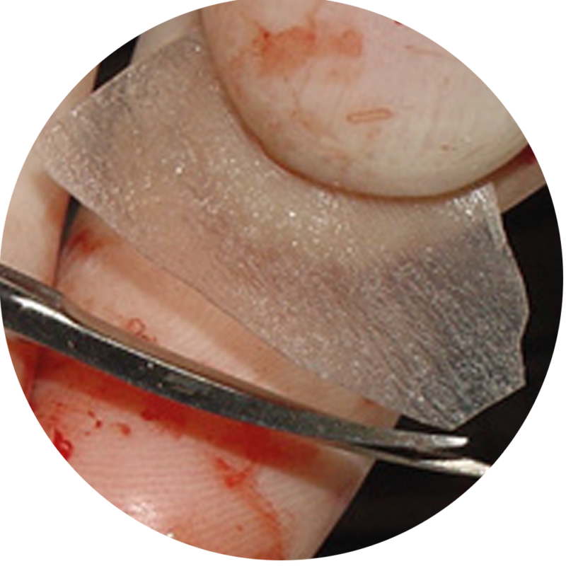 Membrana Óssea Lumina-Dermal Reabsorvível de Periósteo 0,2x20x30mm 3