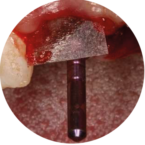 Membrana Óssea Lumina-Dermal Reabsorvível de Periósteo 0,2x20x30mm 5