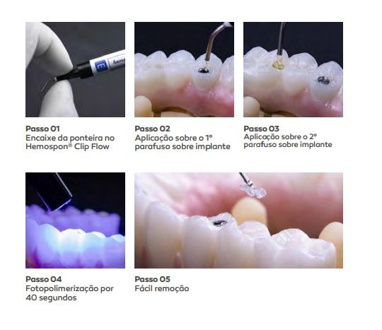 Restaurador Provisório Hemospon Clip Flow 2